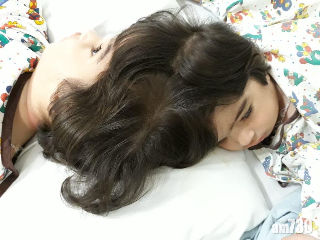 頭部相連雙胞胎女嬰成功分割　手術逾50小時動員100名醫護