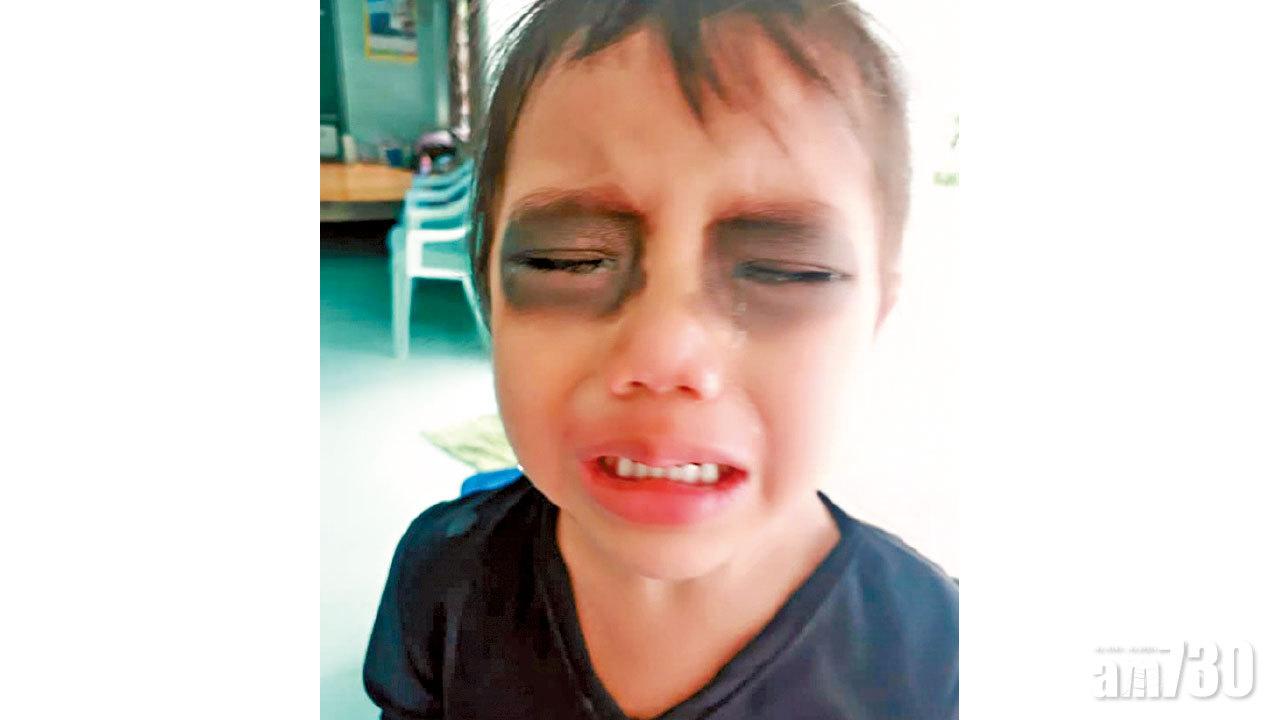 阿媽「熊貓眼」奇招 阻女兒沉迷手機