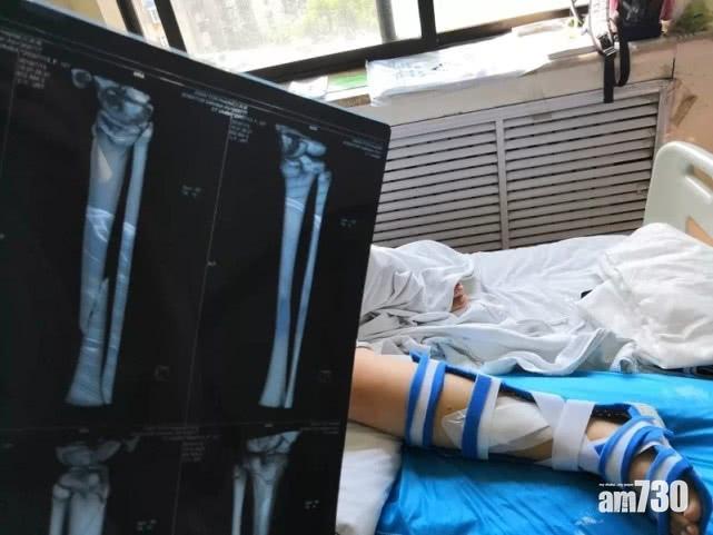 山東女童跳彈床跌斷腳 家屬質疑設備不安