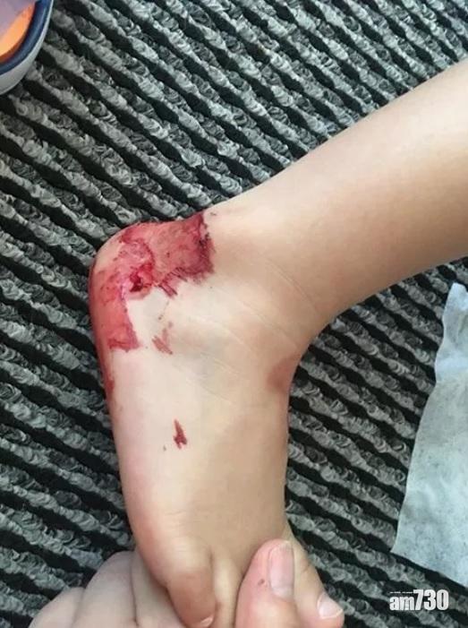 【家長注意】2歲童穿膠涼鞋10分鐘  腳踝嚴重破損流血