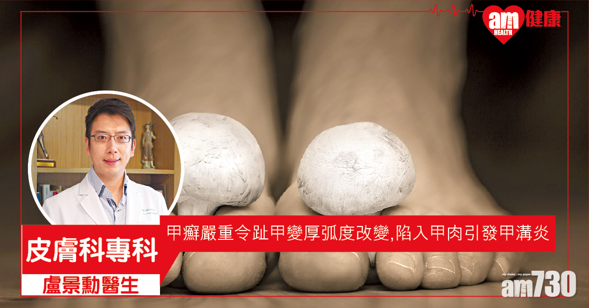 保持衛生乾爽 預防甲癬