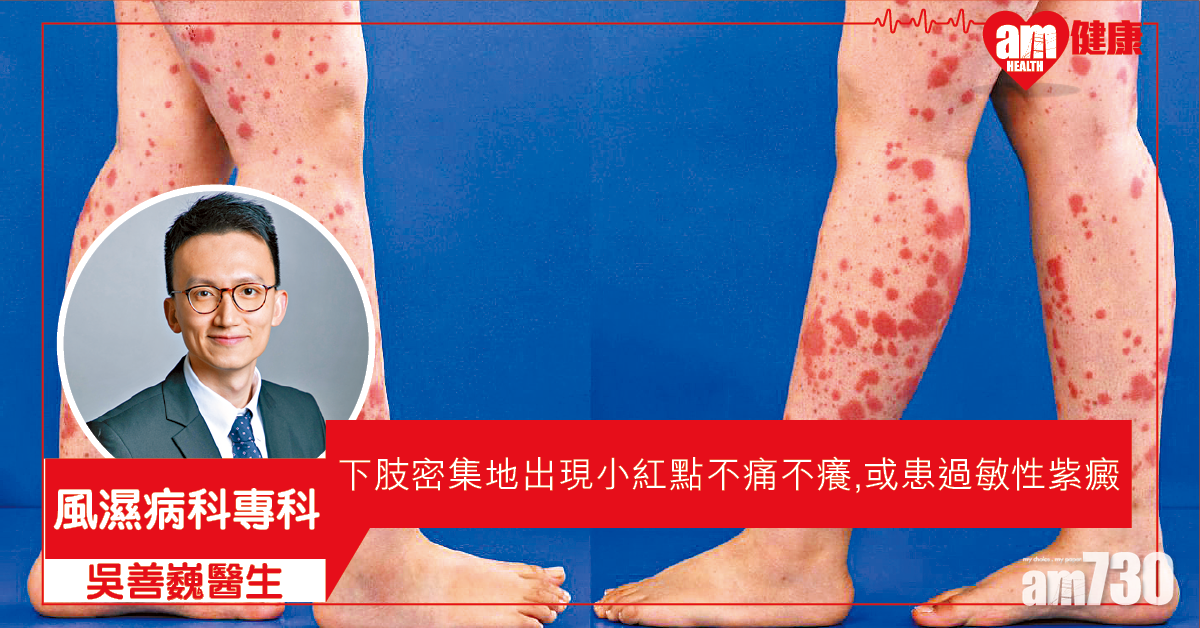 下肢現紅點 過敏性紫癜可傷腎