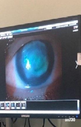20歲女戴隱形眼鏡游水　眼睛受感染變盲