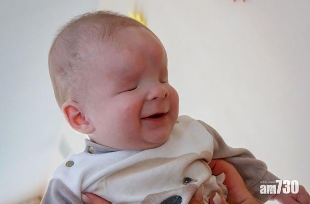 罕見基因病全球僅3例  天生無眼球嬰被遺棄待收養