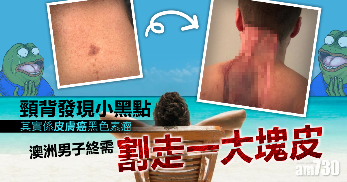 【日光浴要小心】頸背發現黑色素瘤  男子割去一大塊皮