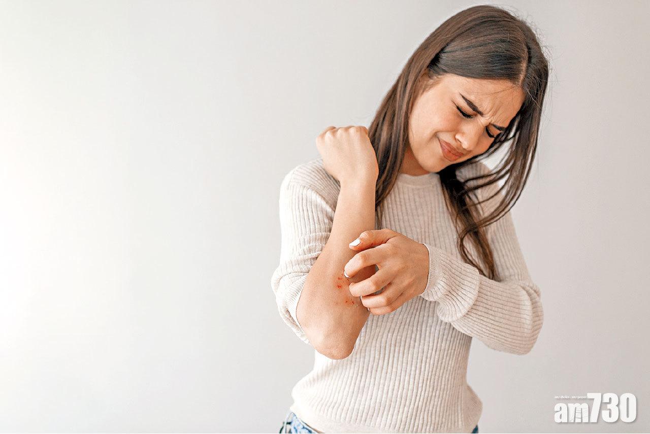 放下有色眼鏡 銀屑病不會傳染