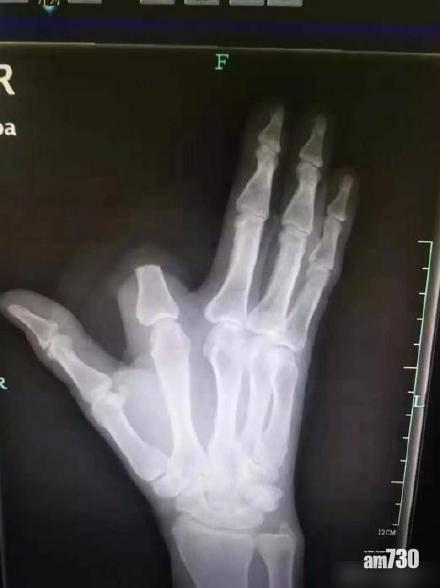 被五步蛇咬傷憂「五步釘」 六旬男斬斷手指