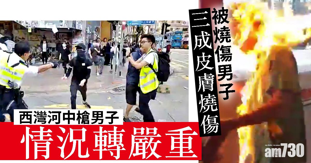 【大三罷】昨日中槍男子情況轉嚴重　被燒傷男子三成皮膚燒傷