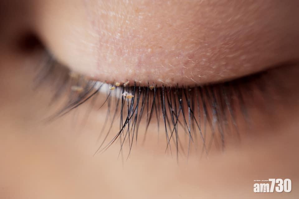 植眼睫毛唔注意衛生　醫生警告︰隨時「生蟲」