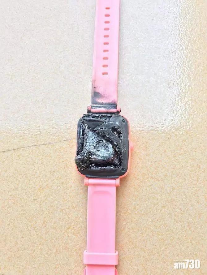 兒童智能手錶突自燃  江門女童手腕燙傷