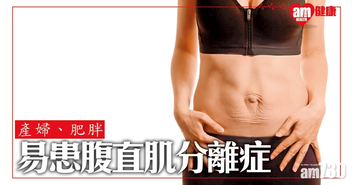 產婦、肥胖易患腹直肌分離症
