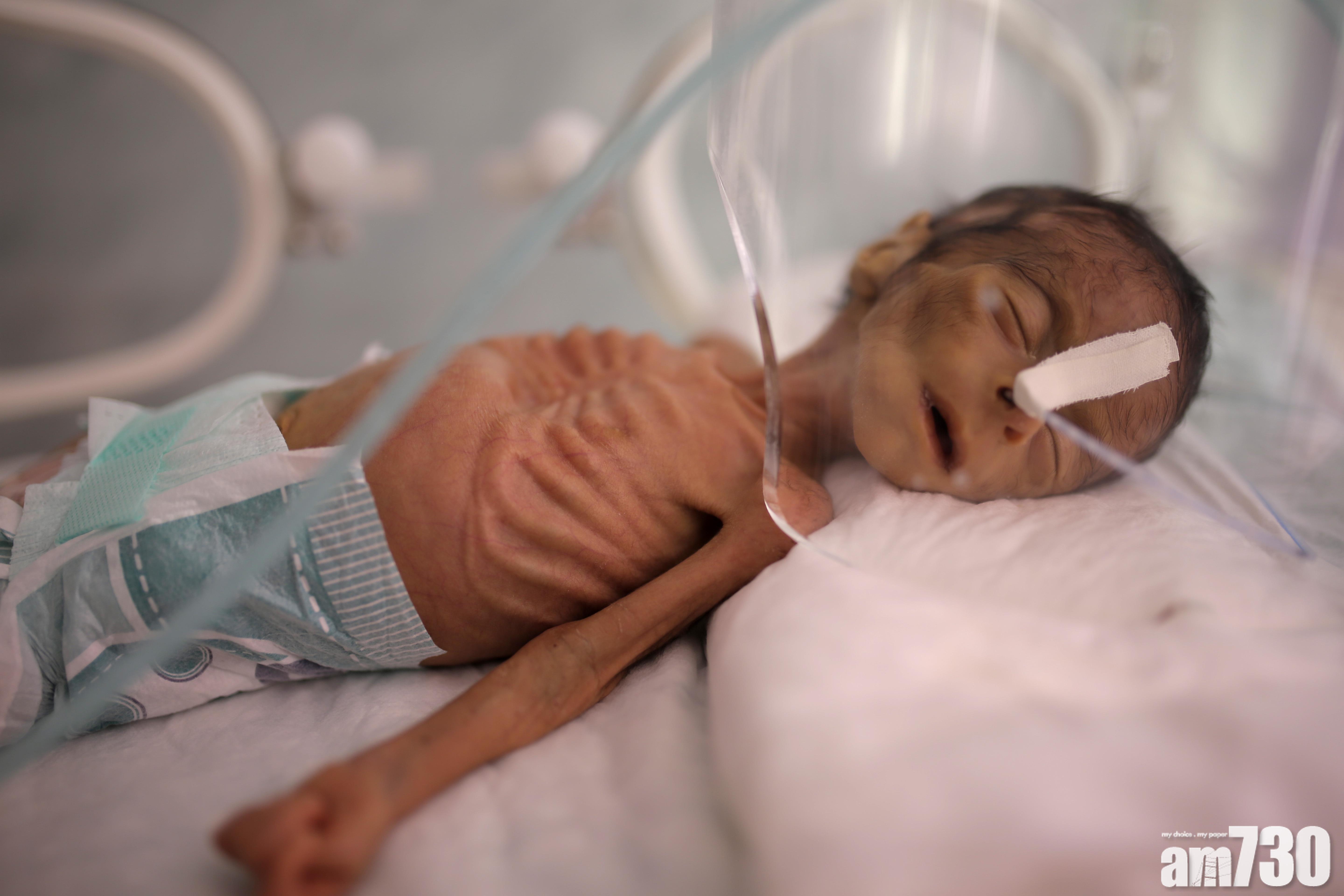 也門內戰5年全國陷飢荒　嬰兒嚴重營養不良皮包骨