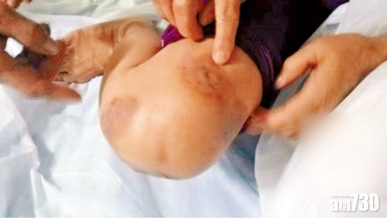 感染惡菌 醫師釘牌 河南百人針灸後爛皮膚