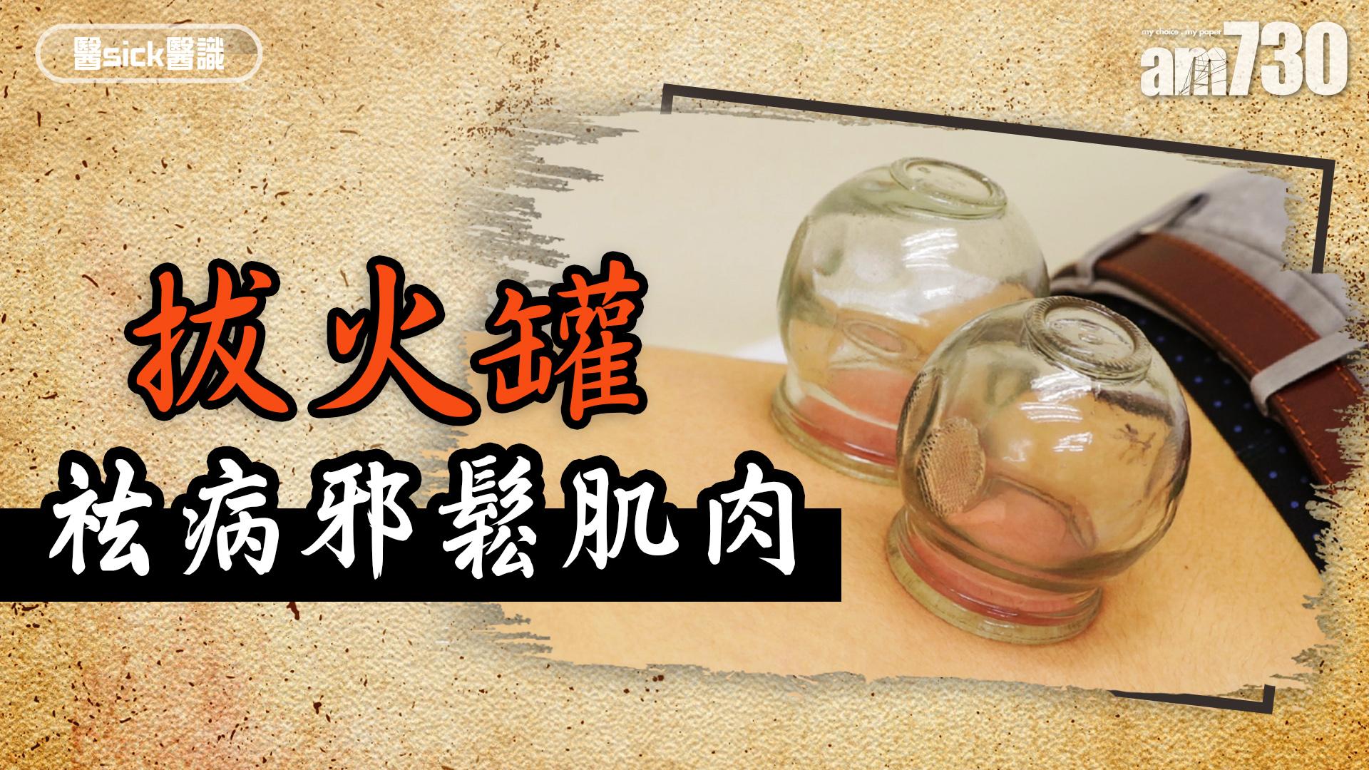拔火罐 祛病邪鬆肌肉