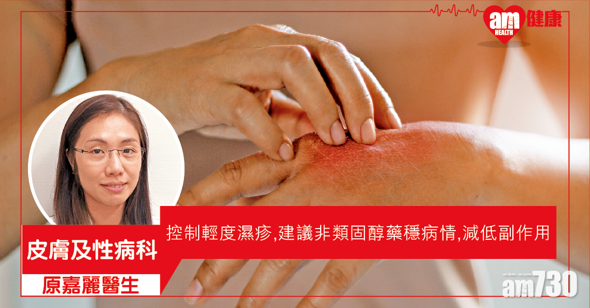 控制輕度濕疹 非類固醇避副作用