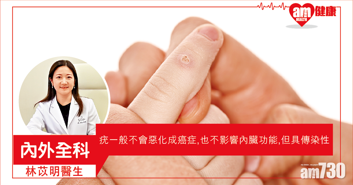 一冷一熱 治療麻煩疣