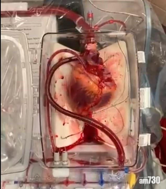 【有助移植】注入氧氣血液電解質  心臟死而復生 