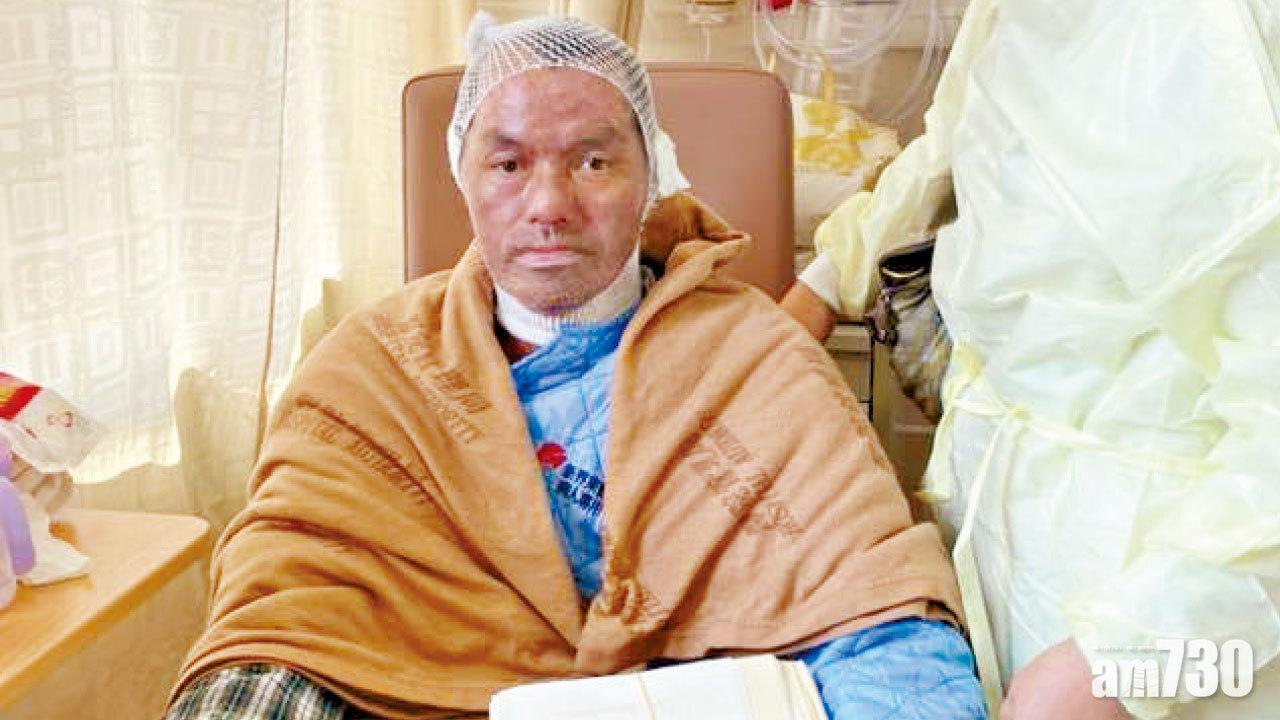 馬鞍山被焚男  情況好轉