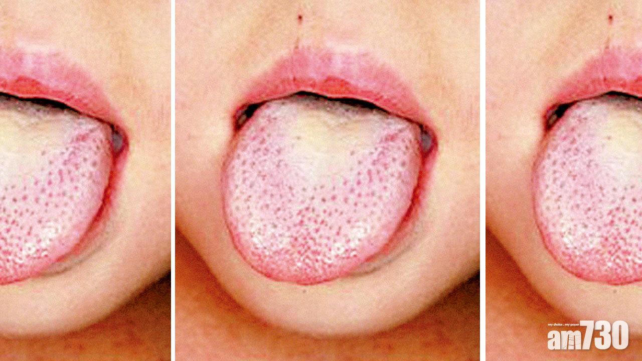 猩紅熱個案升 本周首3日錄46宗