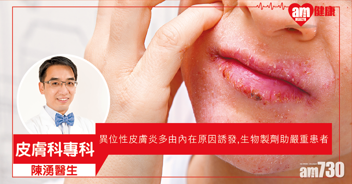 異位性皮膚炎 治療大進步