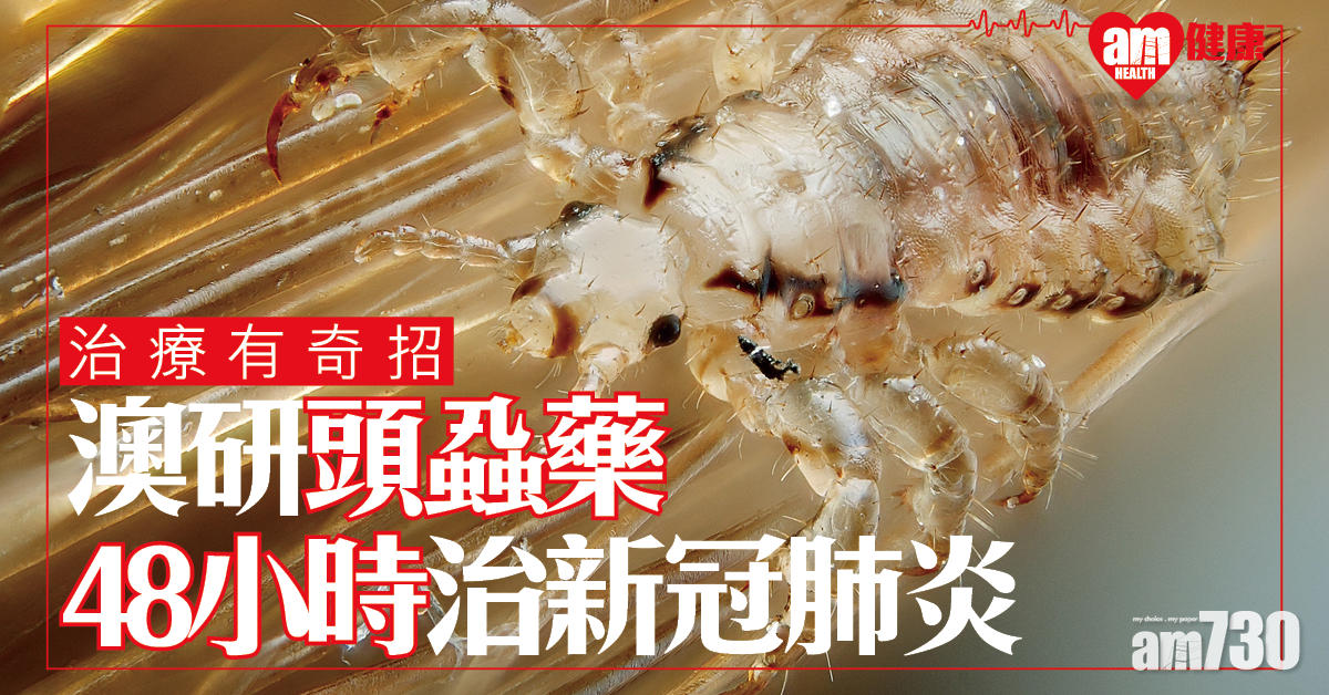 【新冠肺炎】澳洲研究：頭蝨藥能在48小時消滅新冠病毒