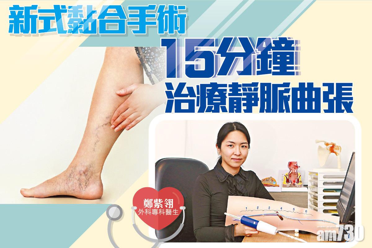 新式黏合手術　15分鐘治療靜脈曲張