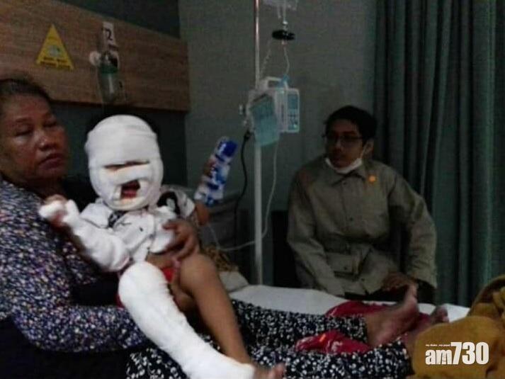 【新冠肺炎】印尼3歲童玩搓手液樽仔引火焚身 窮父因封城無法返家照料