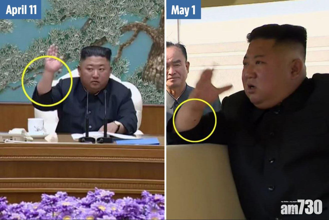 【金仔現身】金正恩手腕留針疤  專家︰疑曾「通波仔」 