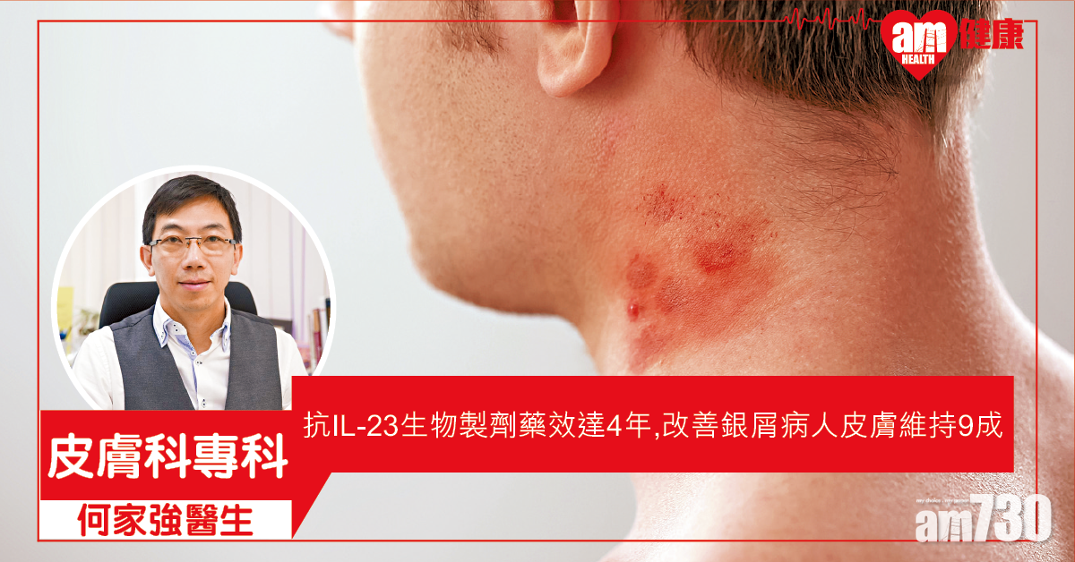 改善抗藥性 新型生物製劑長效控制銀屑病