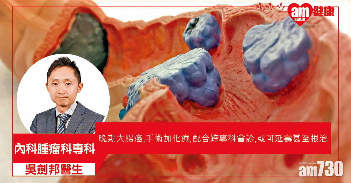 新組合治療 腸癌擴散有得醫