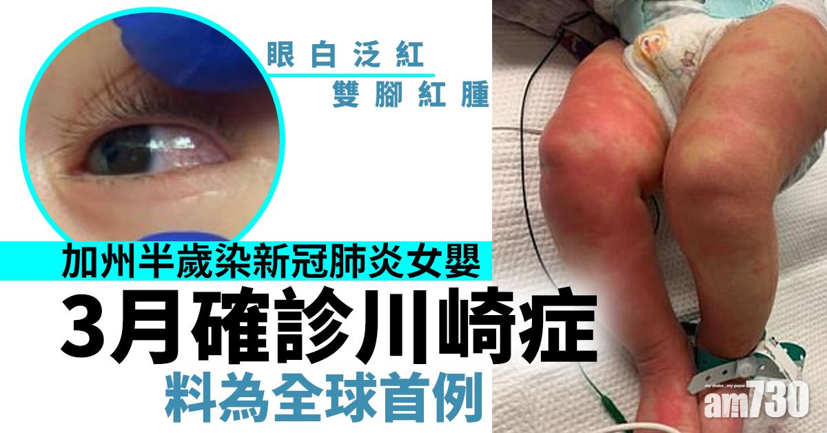 【新冠肺炎】加州半歲染疫女嬰3月確診川崎症　料為全球首例