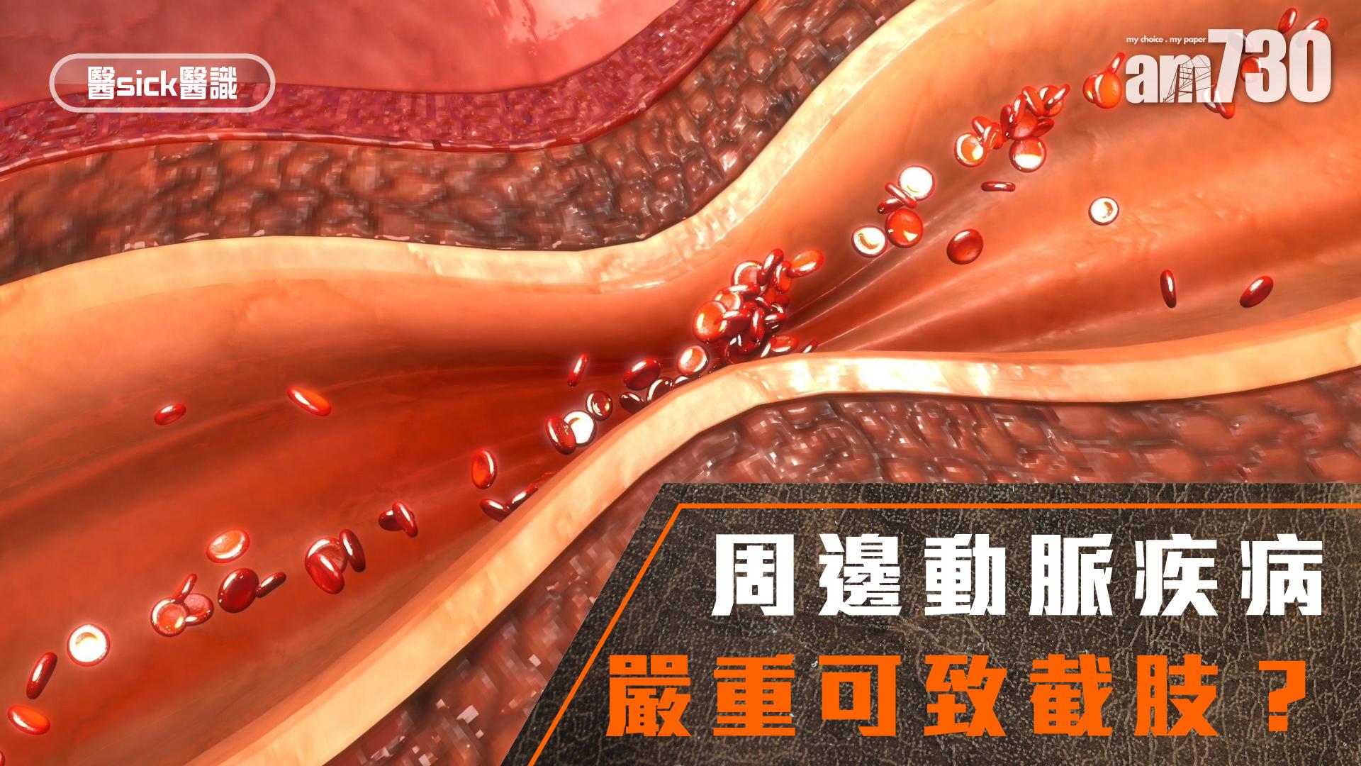 周邊動脈疾病 嚴重可致截肢？