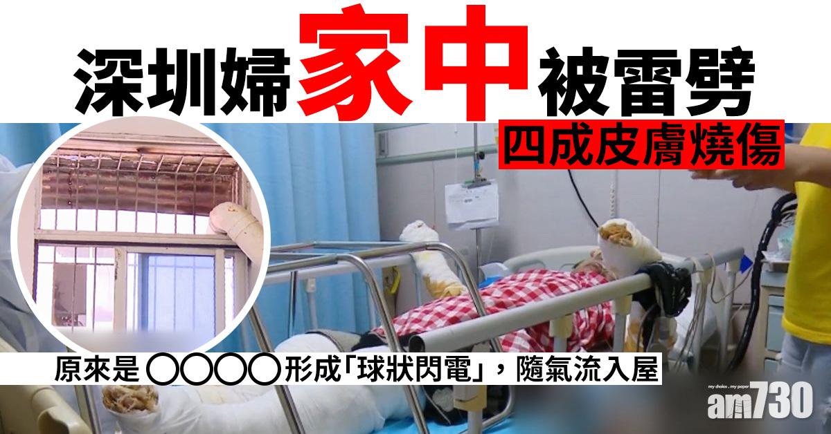 深圳婦家中被雷劈 四成皮膚燒傷