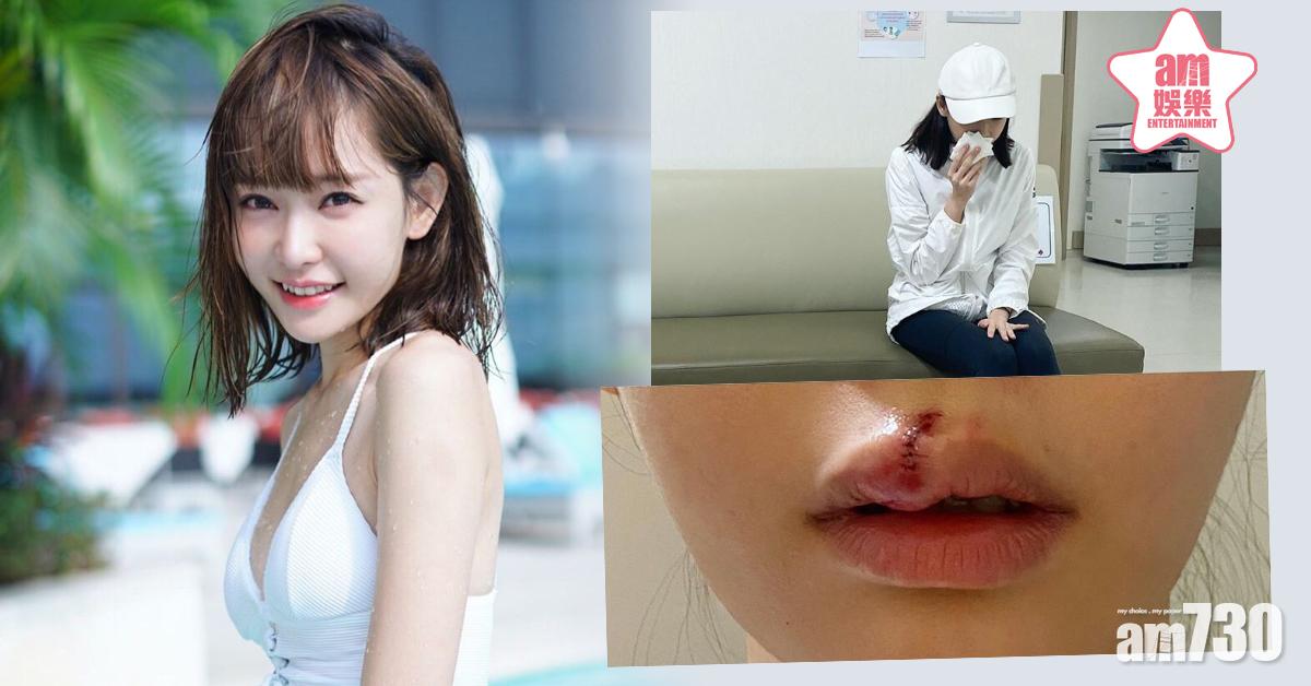 Aka@SG俾狗咬 上唇縫9針險毀容