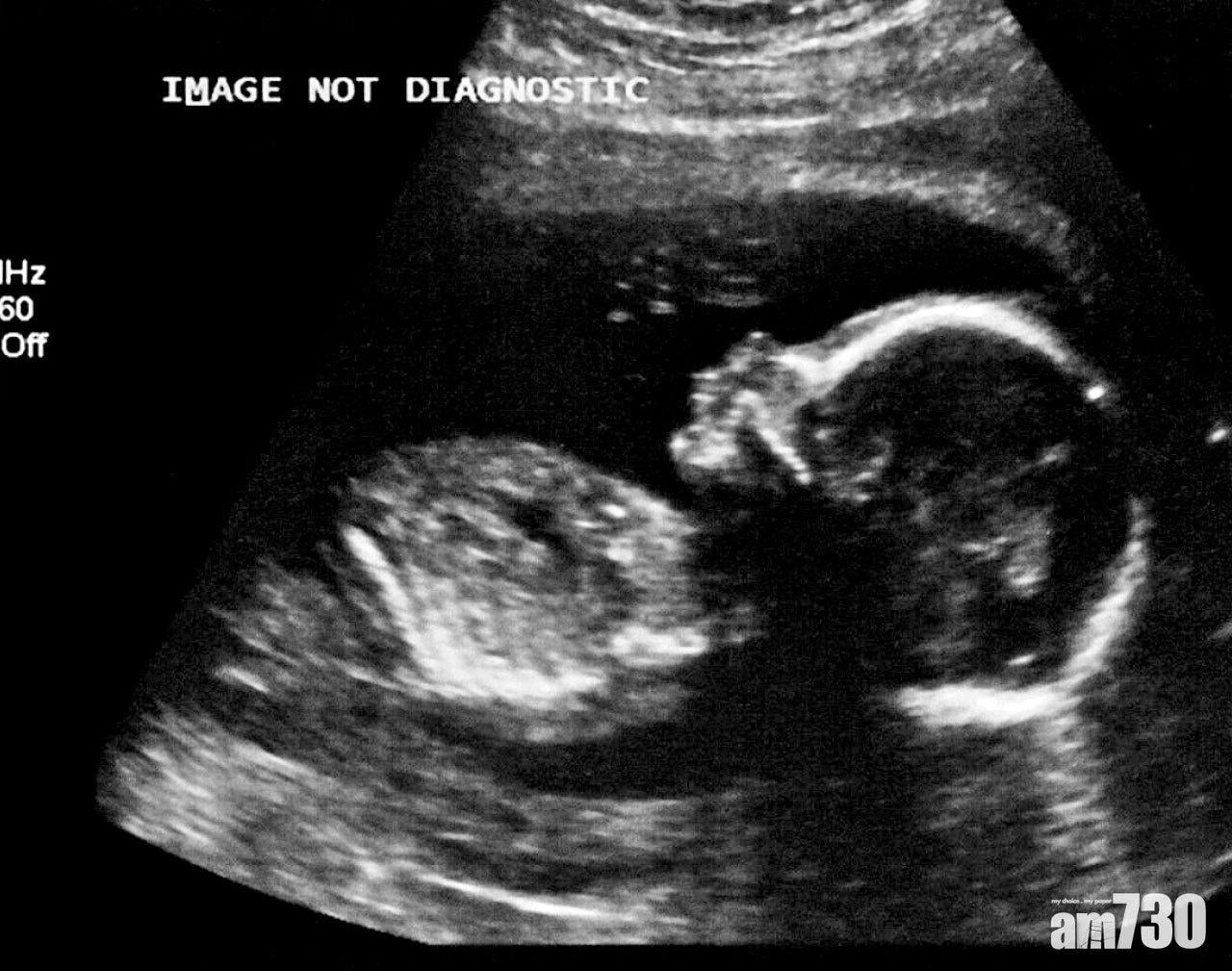 美疫苗開展第三階段試驗 研究首證胎兒經母體染疫