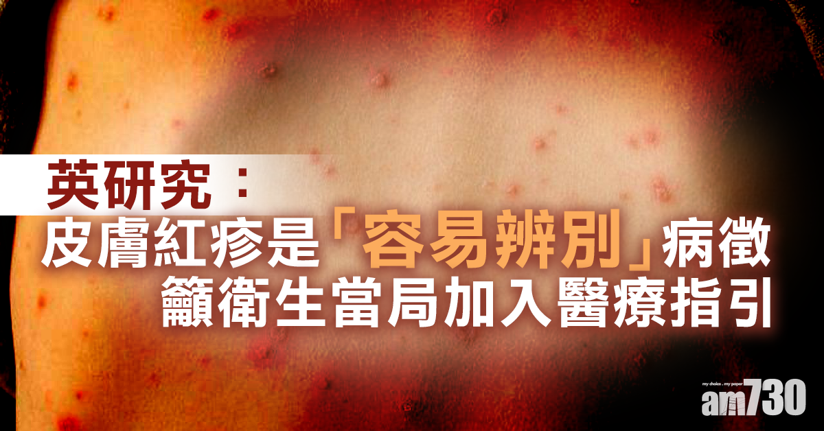 【新冠肺炎】英研究：皮膚紅疹是「容易辨別」病徵 籲衛生當局加入醫療指引