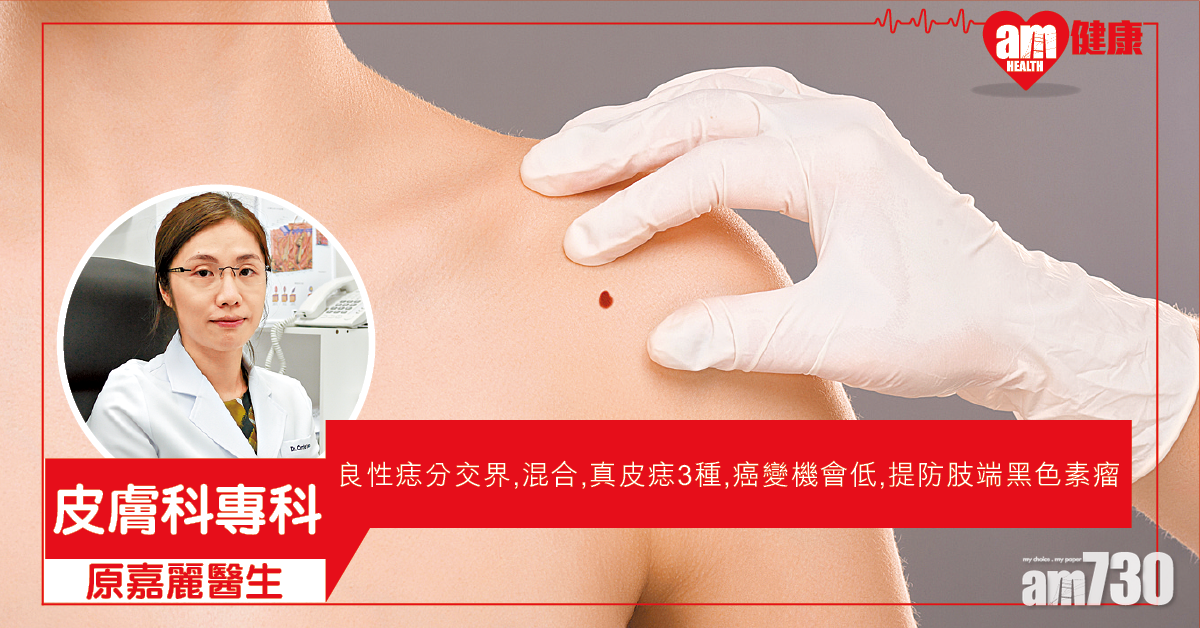 痣變癌 ? 留意ABCDE