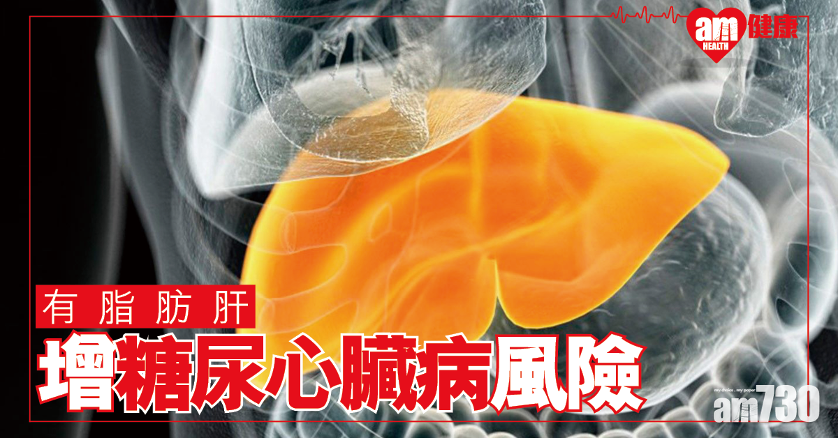 研究證脂肪肝增糖尿病及心臟病風險
