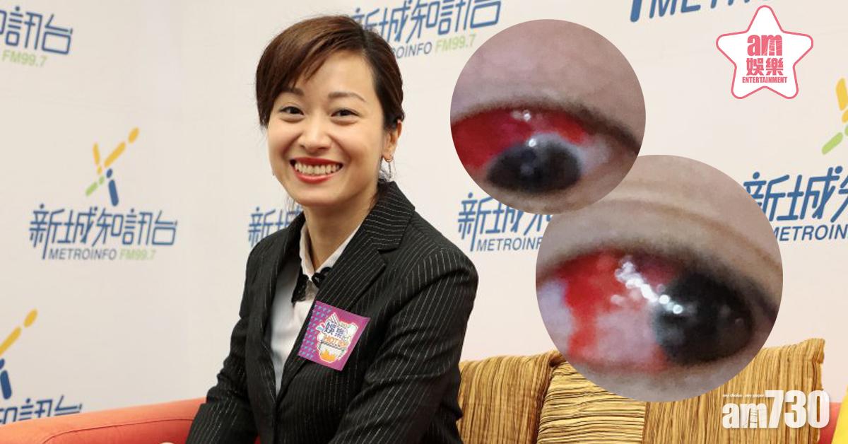 蓋世寶眼白充血勁恐怖 自爆離開無綫賣車斷Wifi慳住過活