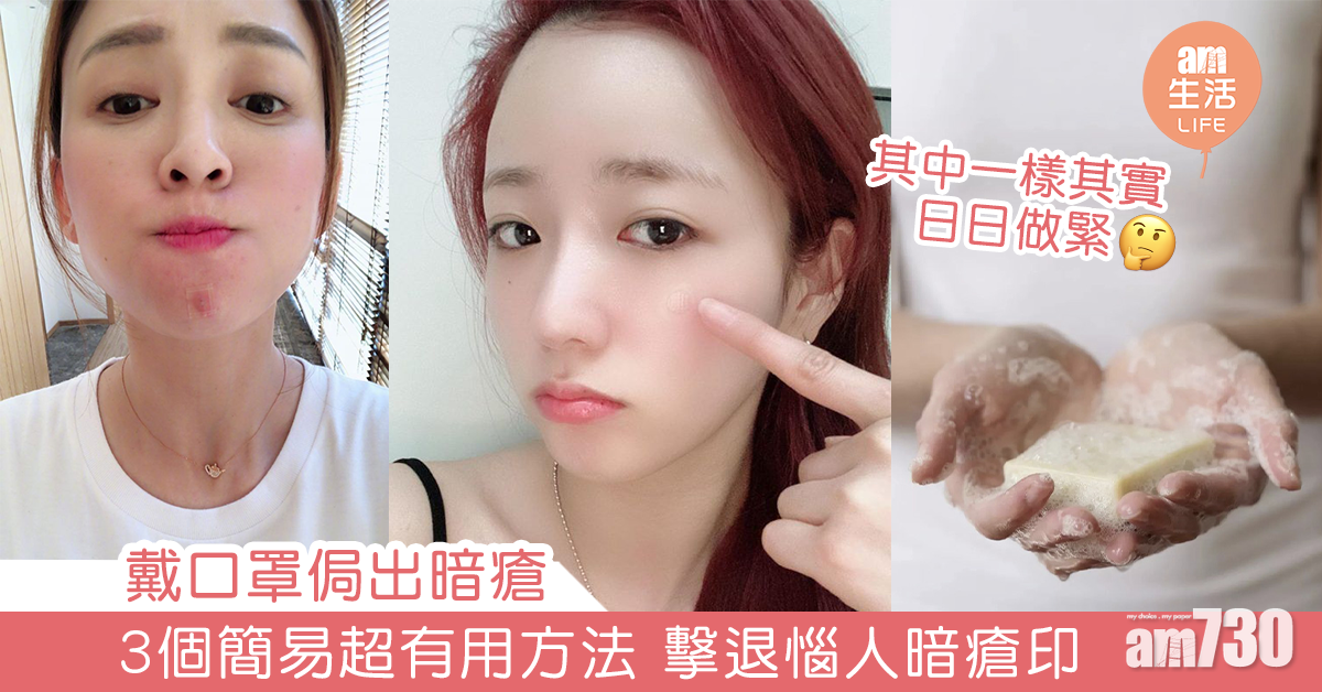 戴口罩侷出暗瘡 3個簡易超有用方法 擊退惱人暗瘡印