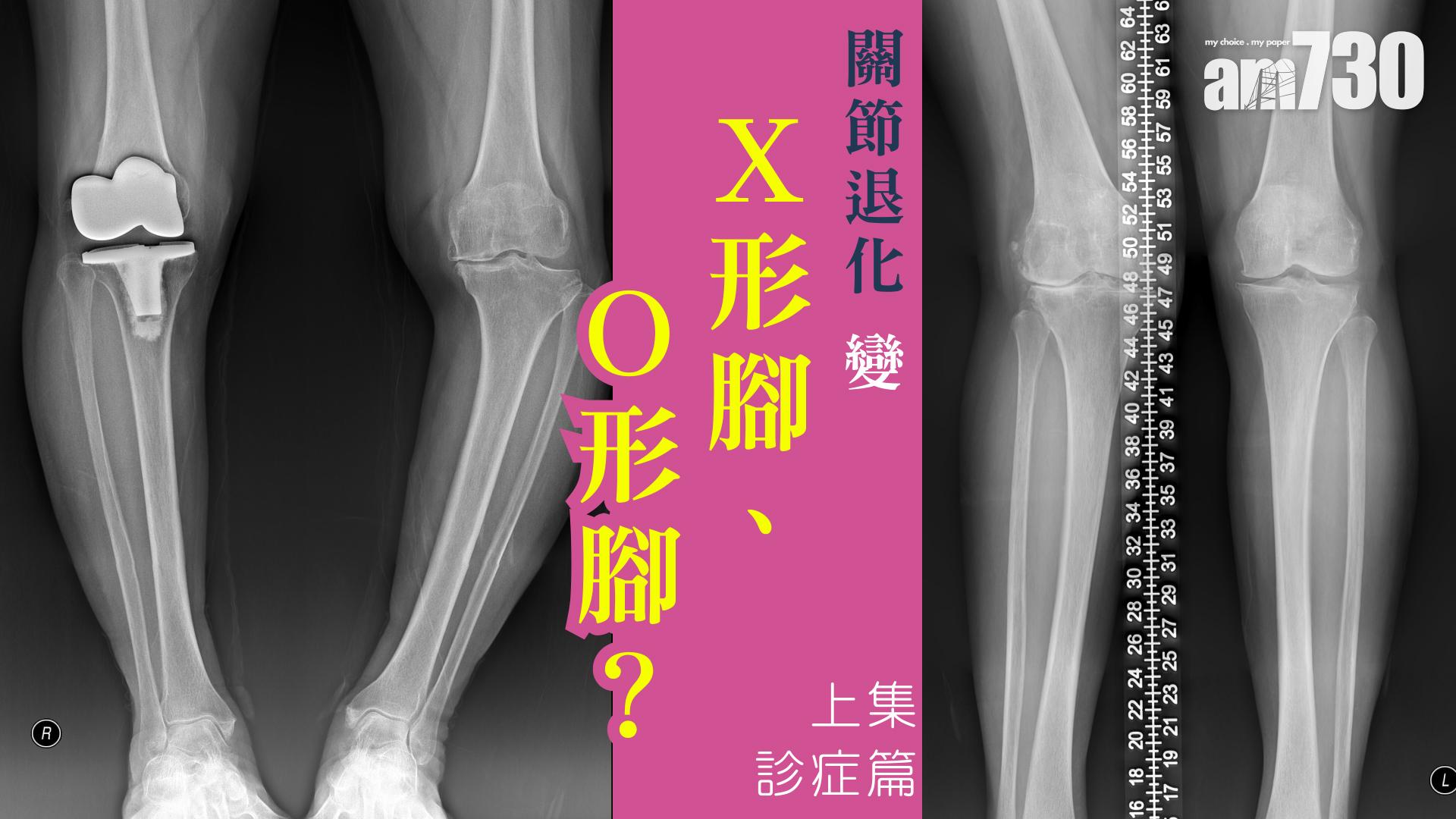 關節退化 變X形腳、O形腳？診症篇