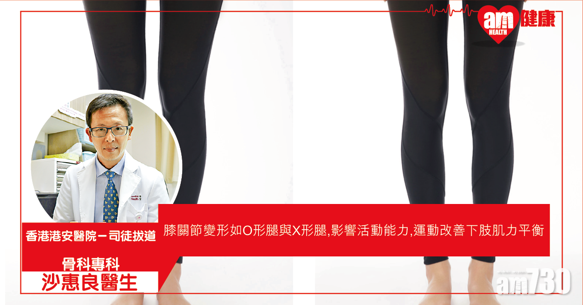 膝關節變形 勿等痛才醫