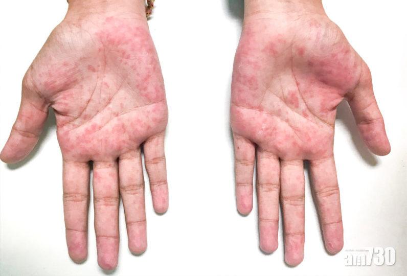 【新冠肺炎】美疾控中心：染病成人併發「川崎症」如兒童可致命