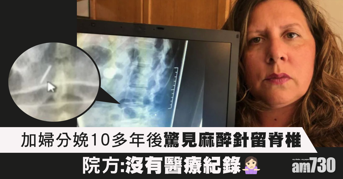 【醫療失誤】分娩10多年後驚見麻醉針留脊椎 加婦：無法移除很徬徨