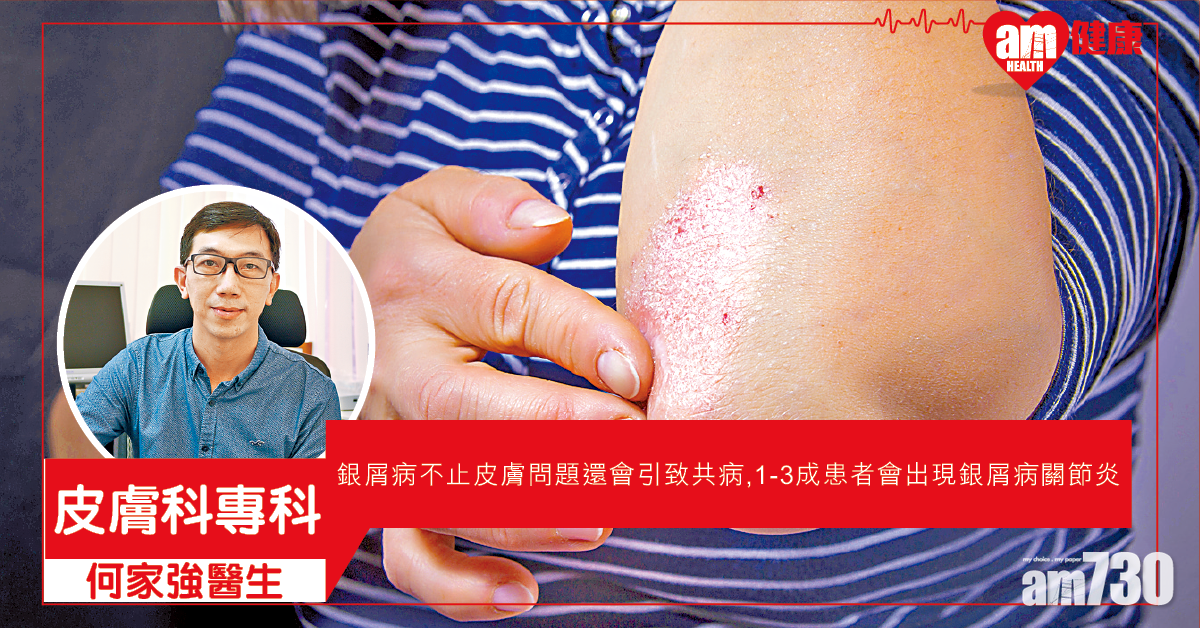 控制銀屑病 回復正面人生