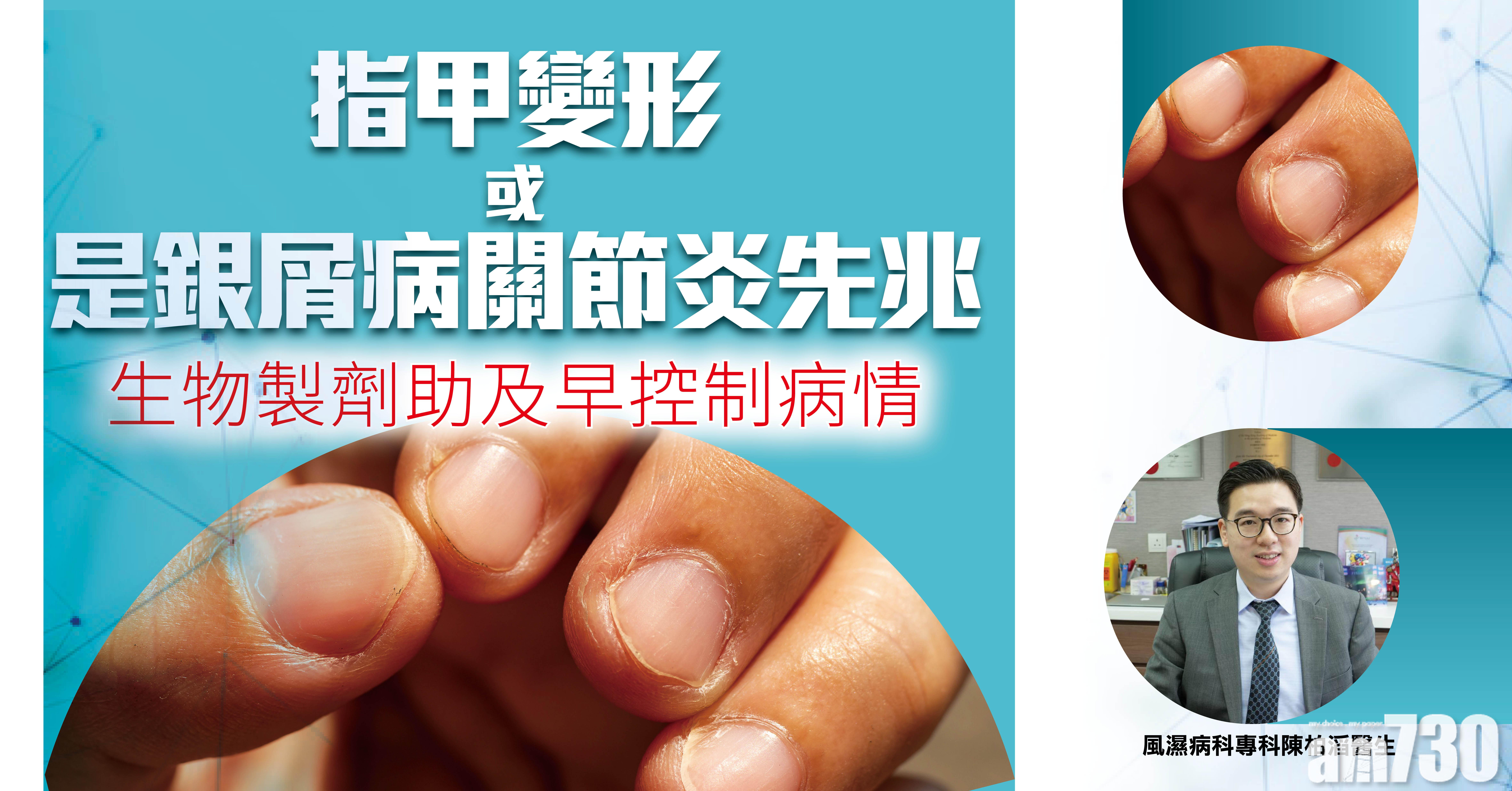 [健康快訊] 指甲變形或是銀屑病關節炎先兆 生物製劑助及早控制病情