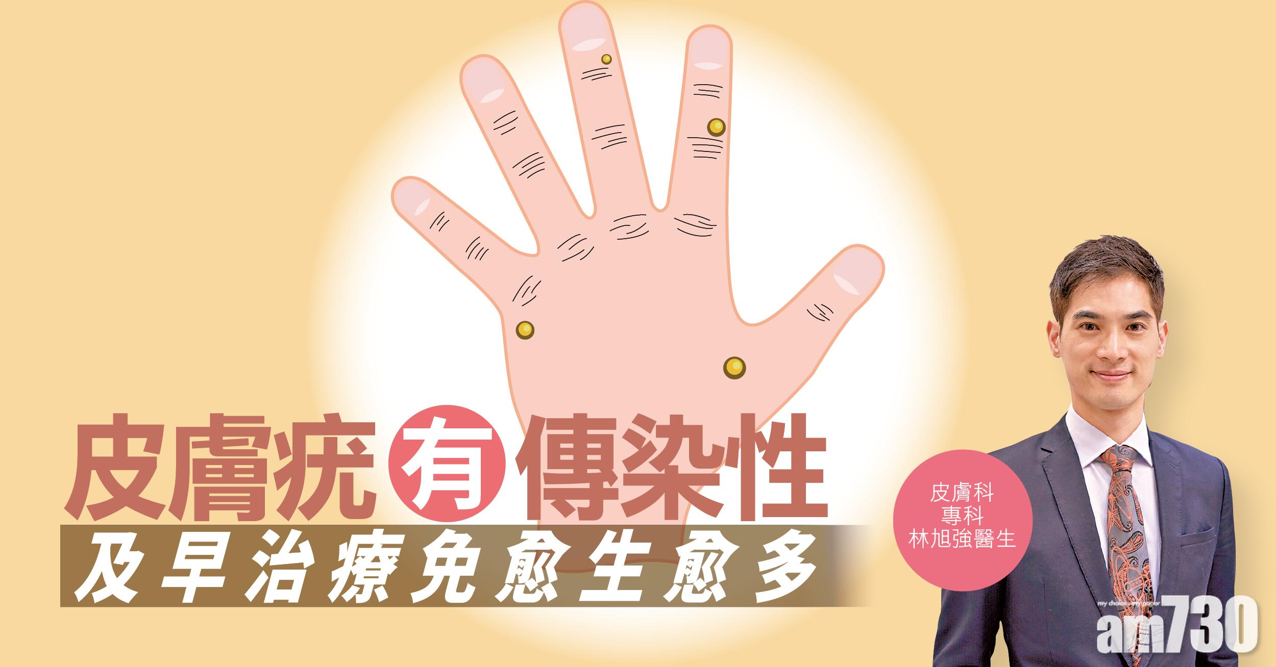 [健康解碼] 皮膚疣有傳染性 及早治療免愈生愈多