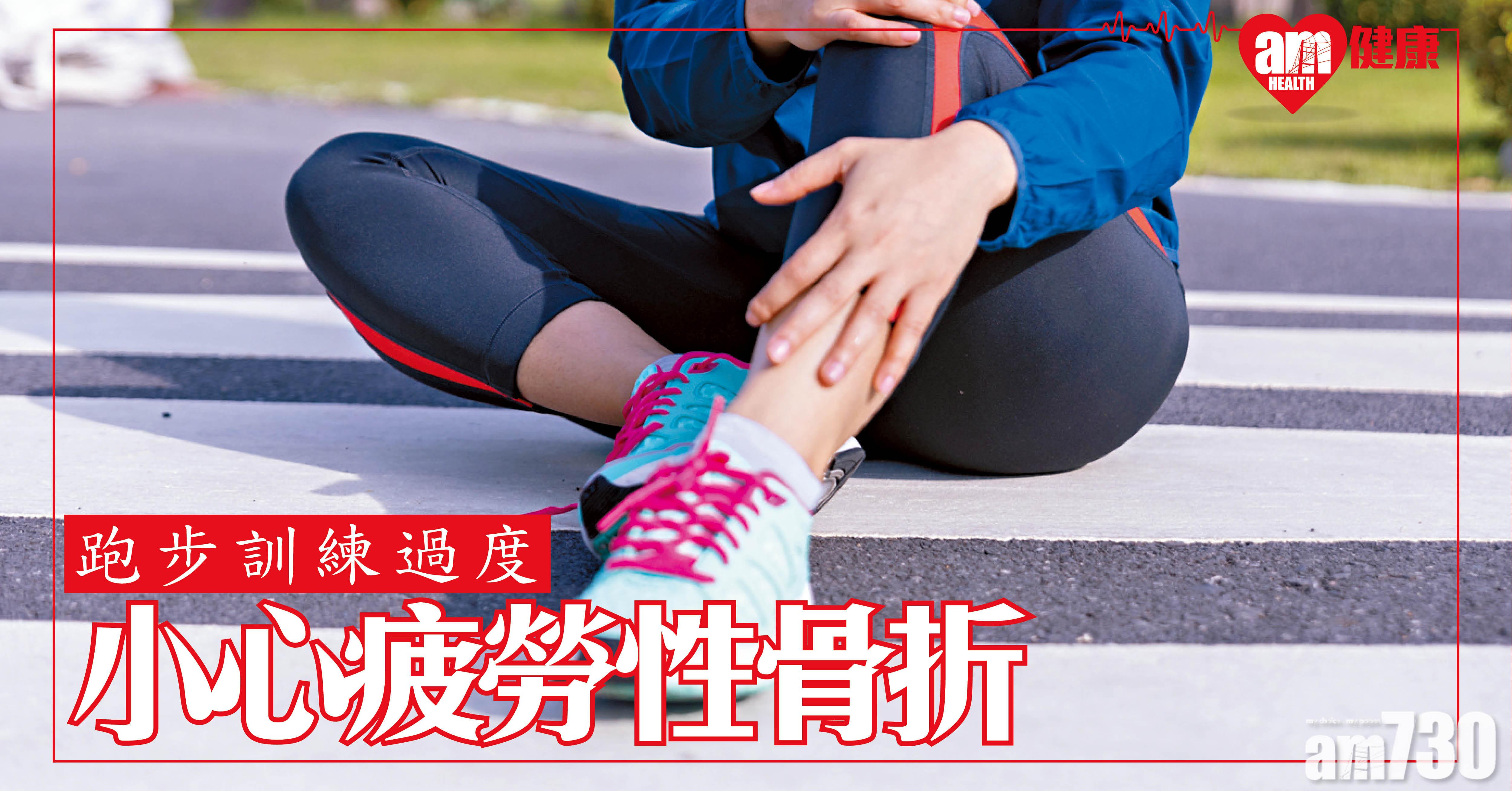 跑步訓練過度 小心疲勞性骨折