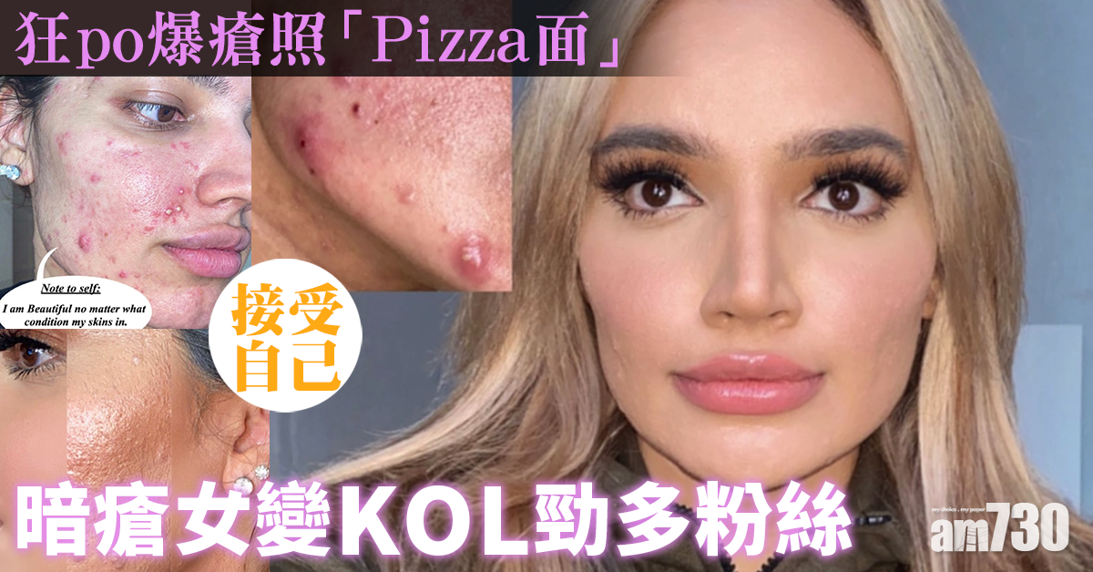 【自我認同】狂po爆瘡照  「Pizza面」暗瘡女變KOL  勁多粉絲 