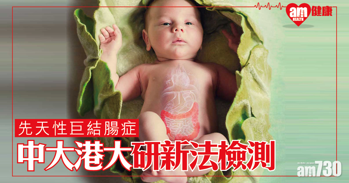 中大與港大研發新法 檢測先天性巨結腸症致病基因